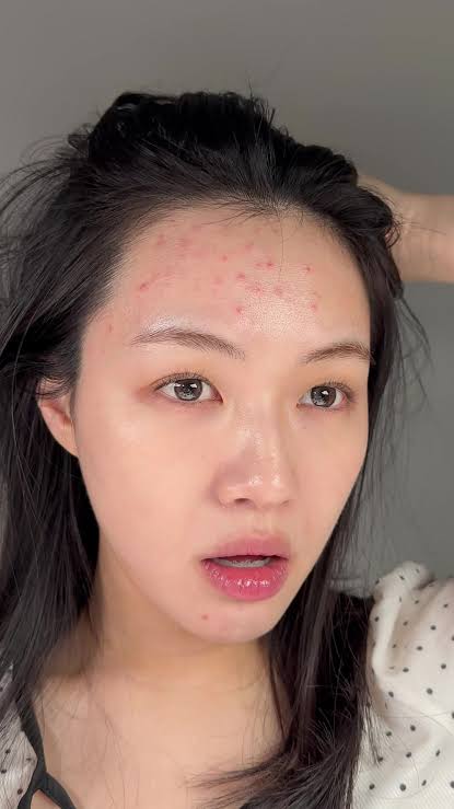 Acne Care & Breakout Treatment